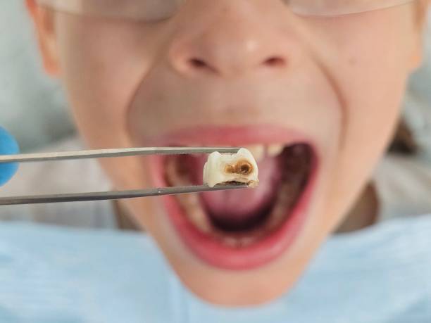 Best Emergency Treatment for Toothache in Millville, NJ